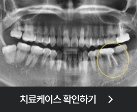 365플러스 임플란트 치료케이스 확인하기